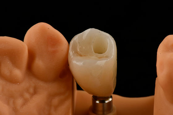 Titanium Single Tooth Dental Implants Internal Hex Connection Typ für eine optimale Passform