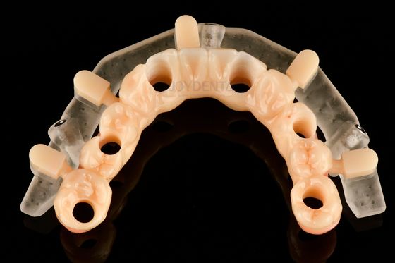 3D-gedruckte Vorlagen für präzise Implantatplatzierung