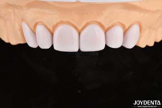 Zahnfineren für fehlerhafte Zähne Biokompatibilität