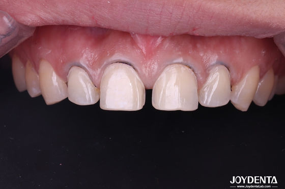 Kosmetische Zahnmedizin Dental Veneers Lab