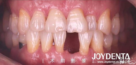 Anpassungsfähige Dental Maryland Harz gebundene Brücken für vordere und premolare Zähne