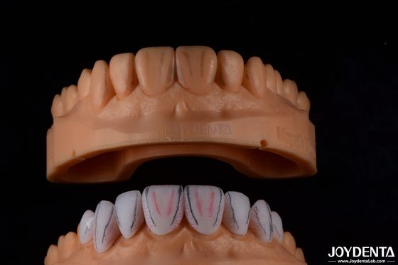 Maßgeschneiderte Dental Emax Keramik Veneers mit Schmutzfestigkeit