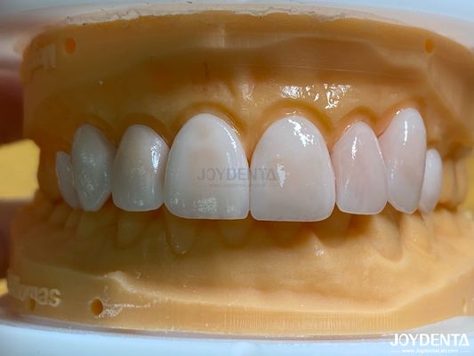 Hohe Durchlässigkeit Natürliche Veneers Porzellan Veneers Emax kundenspezifisch