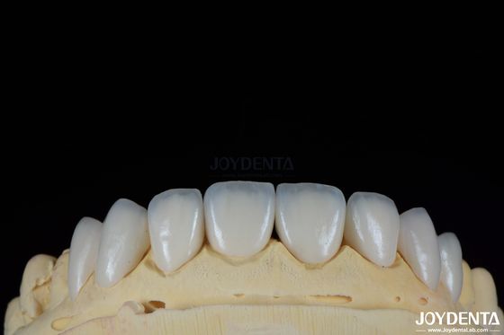 Glänzende Oberflächenstruktur Feldspatische Veneer Naturliche Porzellan Veneer