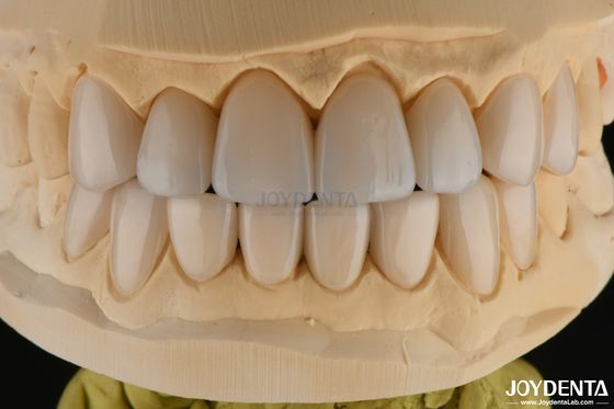 0.3-0.5mm Dicke Feldspatische Porzellan Veneer Hoch Bruchfestigkeit Verbessern Sie Ihr Lächeln