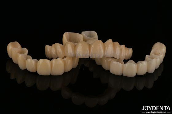 Natürliche Porzellanschicht Zirkoniebrücken Verschleißbeständigkeit Hohe Biokompatibilität
