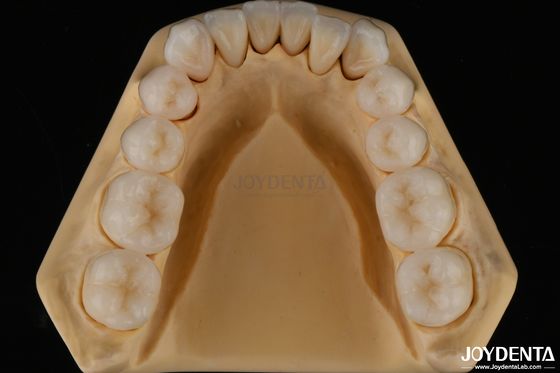 3D-Mehrschicht-Zahnbehandlung Vollzirkonium Spaltbeständigkeit Natürliche Zahnstruktur