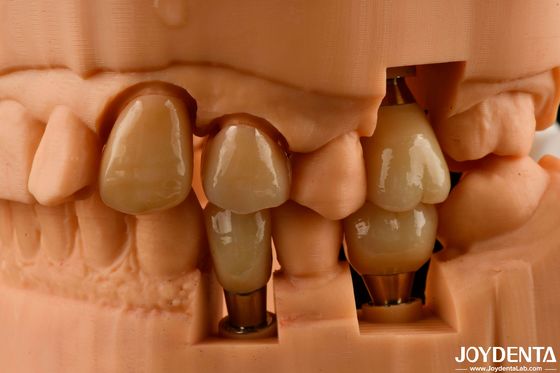 Anpassbare Implantatkrone und -brücke bringen einen natürlichen Look mit dauerhaften Ergebnissen