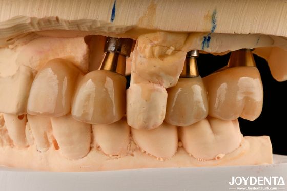 Wiederherstellung von fehlenden Zähnen Implantat Krone und Brücke sicher für den Mund mit genauer Passform