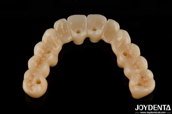 Hochflexible Zirkonie-Hybridbrücke mit Titanbasis