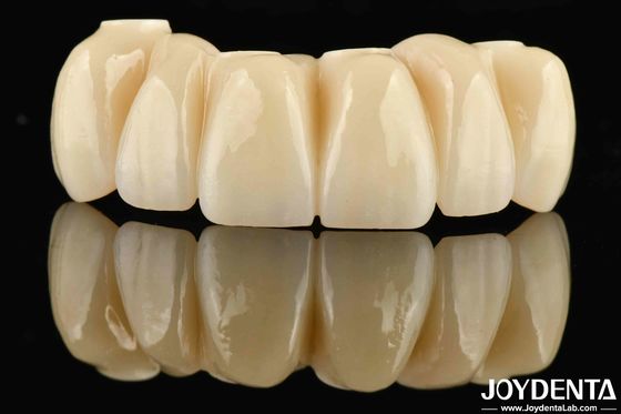 Zahnrestaurierung Ti-Base Zirkonia Hybridbrücke Natürliche Aussehen Präzise Passform