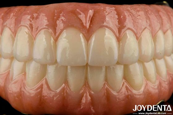 Präzise Zahnpflege Ti-Bar Zirkonia Hybridbrücke Ersatz für fehlende Zähne