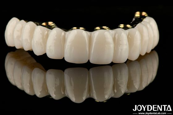 Glatte Hybrid-Zirkonia-Implantatbrücke zur Wiederherstellung der Kauffunktion
