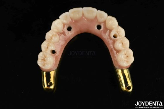 Verschleißbeständige Zirkonia-Hybridbrücke mit Ti-Bar kompatible natürliche Zähne und Zahnfleisch