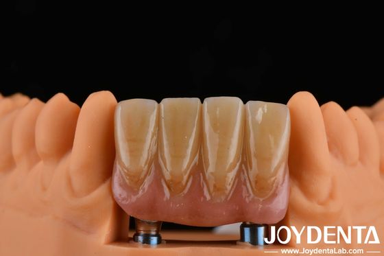 4.5 mm Höhe Fertig Abutments Interne Hex-Verbindung Typ kompatibel mit Implantat-Systemen