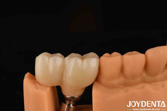 V-förmige Garnart Typ Fertig Abutments Kompatibilität mit allen wichtigen Implantatsystemen