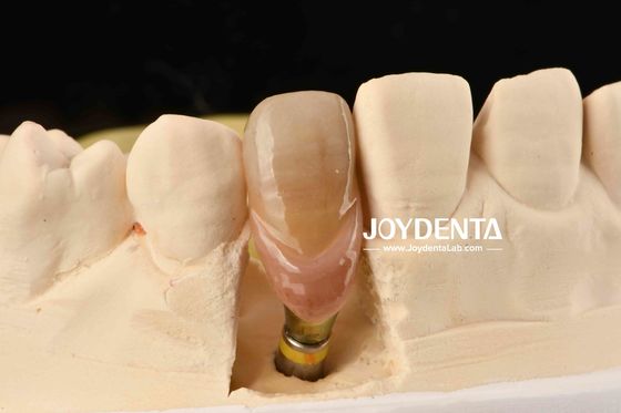 0° Winklung Fertiges Zahn Abutments 1,5 mm Gewinde Schwung Polierte Oberfläche