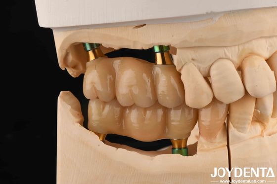 4.5 mm Höhe Polierte innere Hex-Zahnimplantat Abutments V-Form Schraube Behalten