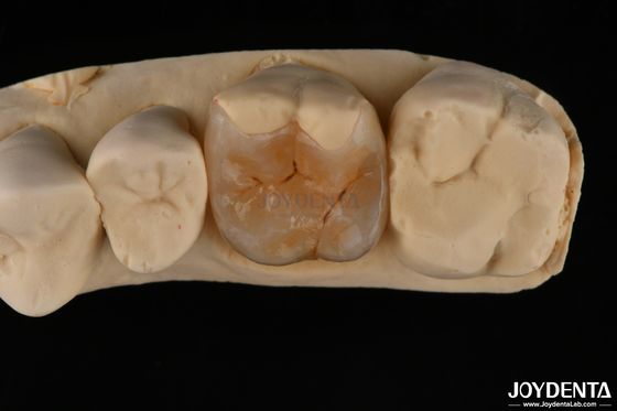 Zusammengesetzte Inlay Onlay für minimal-invasive Zahnrestaurierung
