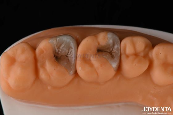 Zusammengesetzte Inlays und Onlays zur Zahnrestaurierung