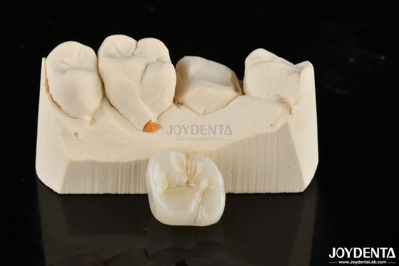 Zirkonia-Inlays und Onlays Maßgeschneiderte Restaurationen für einzigartige Passform und Ästhetik