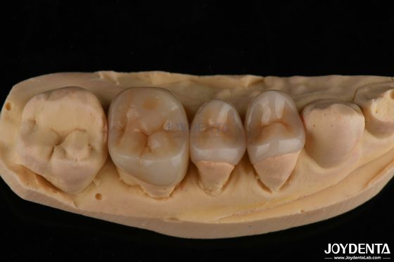 Natürlich aussehende Emax Inlay Onlay Langlebige Zahnrestaurierung 0,5 mm 1 mm 1,5 mm Dicke
