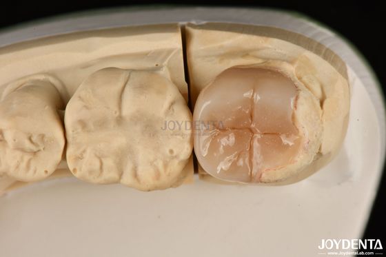Einfache Reinigung Emax Inlays und Onlays Hypoallergene Biokompatible Zahnrestaurationen