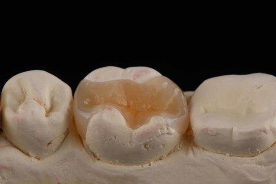E Max Material Inlay und Onlay in der Zahnmedizin Ästhetische Restaurierung Langlebig