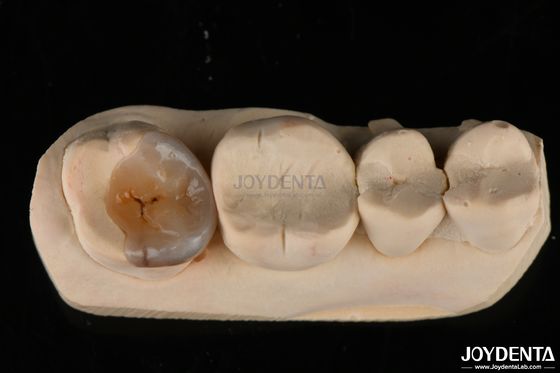 Custom-natürliche Emax-Zahn-Inlays und -Onlays zur Zahnwiederherstellung