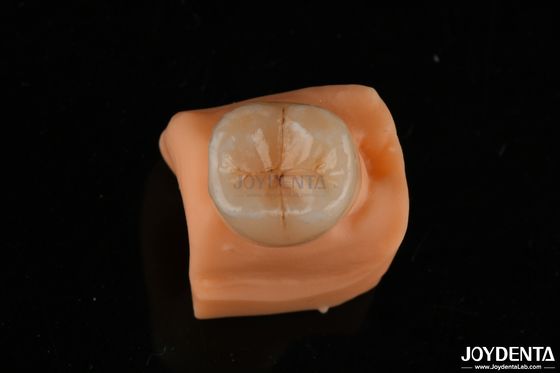 0.5mm Fleckenbeständig Emax Inlay Onlay Genau Passend für Zahnrestaurationen