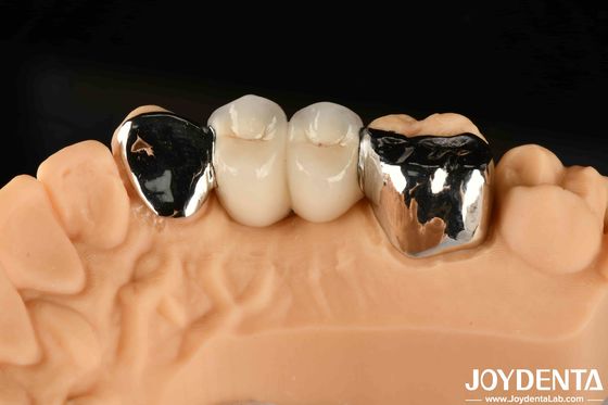Metallische Zahnpflege Maryland gebundene Brücke gute Abhilfe für orale klinische Reparatur