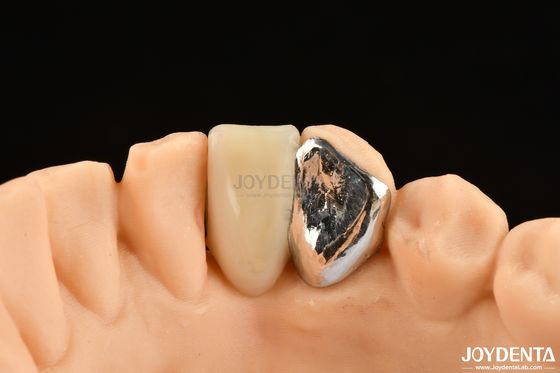 Ideal-Matching-Klinische Bindung Maryland Dental für orale klinische Reparaturarbeiten