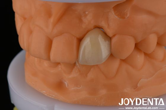Metallisches Material Präzise Färbung EMax Maryland mit idealer Farbmatch