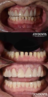 Natürliche Form Kosmetik Zahnmedizin Porzellan Veneers, Zahnmedizin Kosmetik Porzellan Veneers
