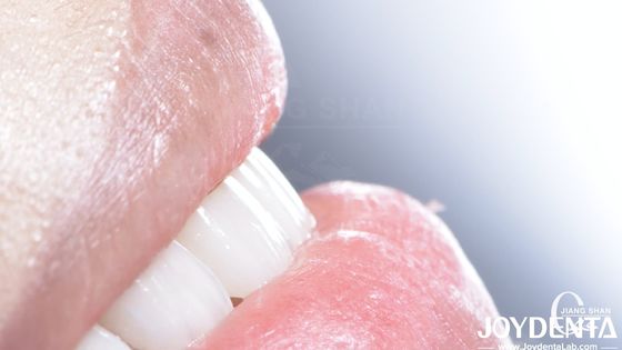Langlebige Dental Composite Veneer Gute Biokompatibilität