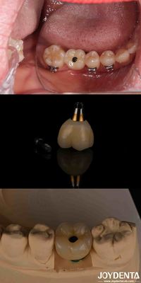 4-6 Zahn-Endossen-Korn-Implantat Subkrestell Knochenhöhe und interne Hex-Verbindung