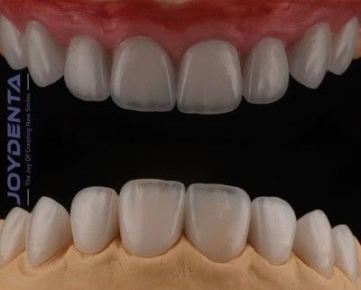 Hochtransparente Feldspatische Veneer, Kosmetische Porzellan Veneer mit starker Haftung