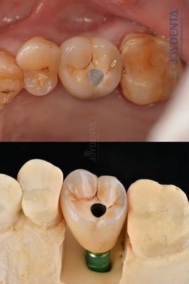 Titanium Vollbogen Zahnimplantate Prothetische Plattform 4,1 mm für außergewöhnliche Haltbarkeit