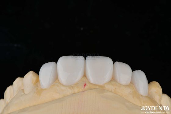 Anpassung Porzellanmaterial Emax Zähne Furnier für hohe Ästhetik Bindung