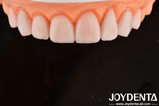 Maßgeschneiderte IPS Porzellan Emax Veneers Zahnrestaurationen Spaltbeständig