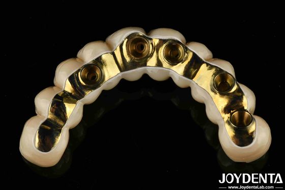 Auf Wunsch gefertigte Ti-Bar Zirkonia Hybrid-Brücke Präzisions-Fit-Zahnprothese