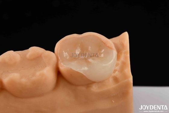 Polymeriertes Porzellan Verbundene Inlay und Onlay Ästhetische und dauerhafte Restaurierungen