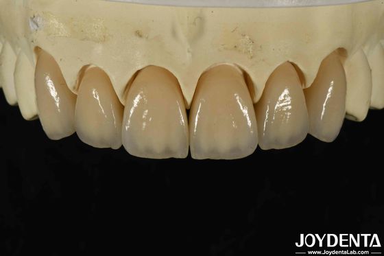 Ausgezeichnete Biokompatibilität Schichtzirkonie mit hoher Ästhetik und Dichte 6,0-6,1 G/cm3