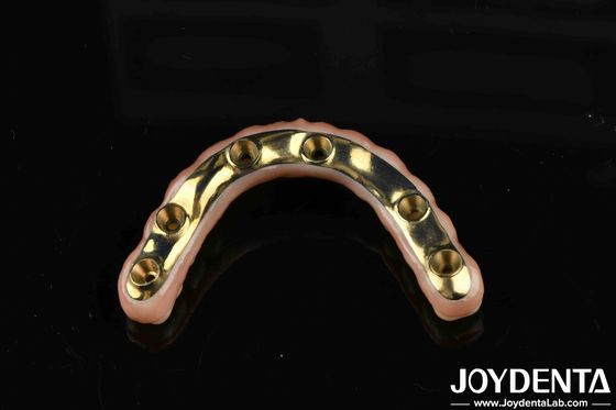 Ti-Bar Zirkonia Hybridbrücke für Komfort und Langlebigkeit bei Zahnreparaturen
