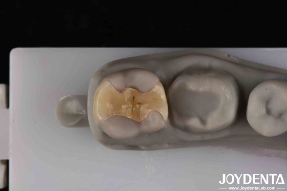 Niedrigtransparente Inlay Onlay sichere Zementation für langlebige und ästhetische Restaurierungen