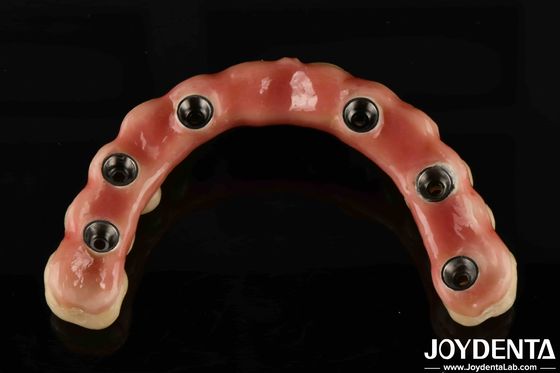 Die verstellbare Titan-Malong-Hybridbrücke ist eine perfekte Kombination aus traditionellen und modernen Techniken.