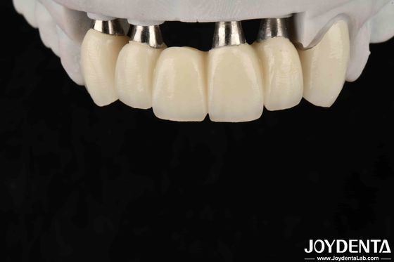 Anpassbare Implantatkrone und -brücke für eine sichere orale Biokompatibilität