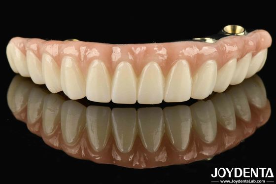 Ti-Bar Zirkonia Hybridbrücke kompatibel mit natürlichen Zähnen und Zahnfleisch Autobiografie Wiederherstellung der Kauffunktion