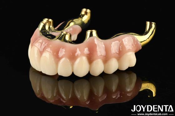 Wiederherstellung der Kauffunktion Ti-Bar Zirkonia Hybridbrücke mit hoher Biokompatibilität und präziser Passform