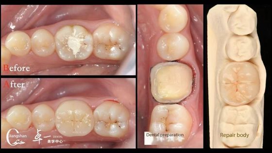 Biokompatibilität und hohe Kompatibilität mit natürlichen Zähnen